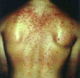 Negative effects of steroids on the skin